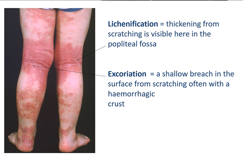 <ul><li><p><strong>Lichenification </strong>= <u>thickening </u>from scratching is visible here in the popliteal fossa </p></li><li><p><strong>Excoriation</strong> = a shallow <strong>breach in the surface</strong><u> from scratching</u> often with a haemorrhagic crust </p></li><li><p><em>This patient has severe atopic eczema.</em></p></li></ul><p></p>