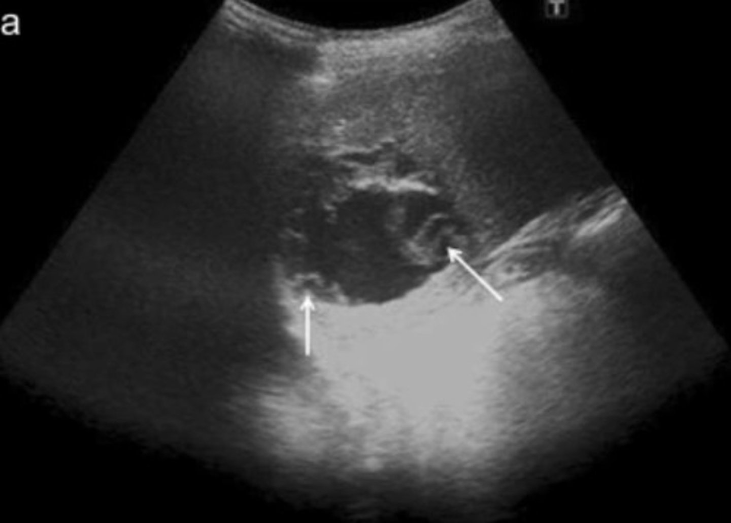 <p>Well defined</p><p>Daughter cysts (loculations)</p><p>Mural calcifications</p><p>Posterior enhancement</p><p>Simple or complex</p>