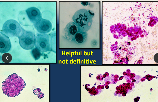<ul><li><p><span style="background-color: transparent;"><strong>Et:</strong> <strong><u>Transitional Cell Carcinoma</u></strong></span></p><ul><li><p><span style="background-color: transparent;"><strong><u>Trigone </u></strong>> Fundus</span></p></li><li><p><span style="background-color: transparent;">Locally invasive and <strong><u>metastasize (lungs) → prone to seeding</u></strong></span></p></li></ul></li><li><p><span style="background-color: transparent;"><strong>Sig:</strong> <strong>Dogs</strong>, old, </span><span style="background-color: transparent; color: blue;"><strong>Scottish</strong></span><span style="background-color: transparent;"><strong> Terrier</strong>, recurrent UTI</span></p><ul><li><p><span style="background-color: transparent;"><u>Cats are low risk</u></span></p></li></ul></li><li><p><span style="background-color: transparent;"><strong>Cs: </strong>Dysuria, stranguria, pollakiuria, hematuria, incontinenc</span></p><ul><li><p><span style="background-color: transparent;"><u>Most dogs = T2/T3 at presentation</u></span></p></li><li><p><span style="background-color: transparent;"><strong><u>RECAL EXAM! esp. females w/ dysuria</u></strong></span></p></li></ul></li><li><p><span style="background-color: transparent;"><strong>Dt: </strong>hematuria, pyuria, malignant epithelial cells, urine culture, Cytology/biopsy, <strong><u>BRAF test </u></strong><u>(cells w/ mutation, high specificity/sensitivity)</u>, imaging</span></p><ul><li><p>can cause obstruction and hydronephrosis</p></li></ul></li></ul><ul><li><p><span style="background-color: transparent;"><strong><u>Risk of seeding during Sx, biopsy, cysto</u></strong></span></p></li></ul><ul><li><p><span style="background-color: transparent;"><strong>Tx: </strong>Partial cystectomy (<80%), <u>piroxicam</u>, chemo, radiation</span></p><ul><li><p><span style="background-color: transparent;"><strong>Palliative: </strong>Tube cystostomy (chronic UTI risk), Urethral stenting</span></p></li><li><p><span style="color: red;"><strong><u>Piroxicam</u> is a non-COX-specific NSAID - <u>Not directly cytolytic</u></strong></span></p></li></ul></li></ul><img src="https://knowt-user-attachments.s3.amazonaws.com/33c2564b-00bc-44ad-bc19-c4c5f8c631dd.png" data-width="50%" data-align="center"><p></p>