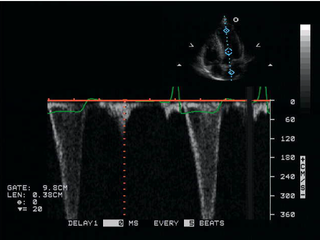 <p>This image was obtained by using which type of Doppler?</p><p></p><p>Continuous wave</p><p>&nbsp;</p><p>High PRF</p><p>&nbsp;</p><p>Pedoff</p><p>&nbsp;</p><p>None of the above</p>