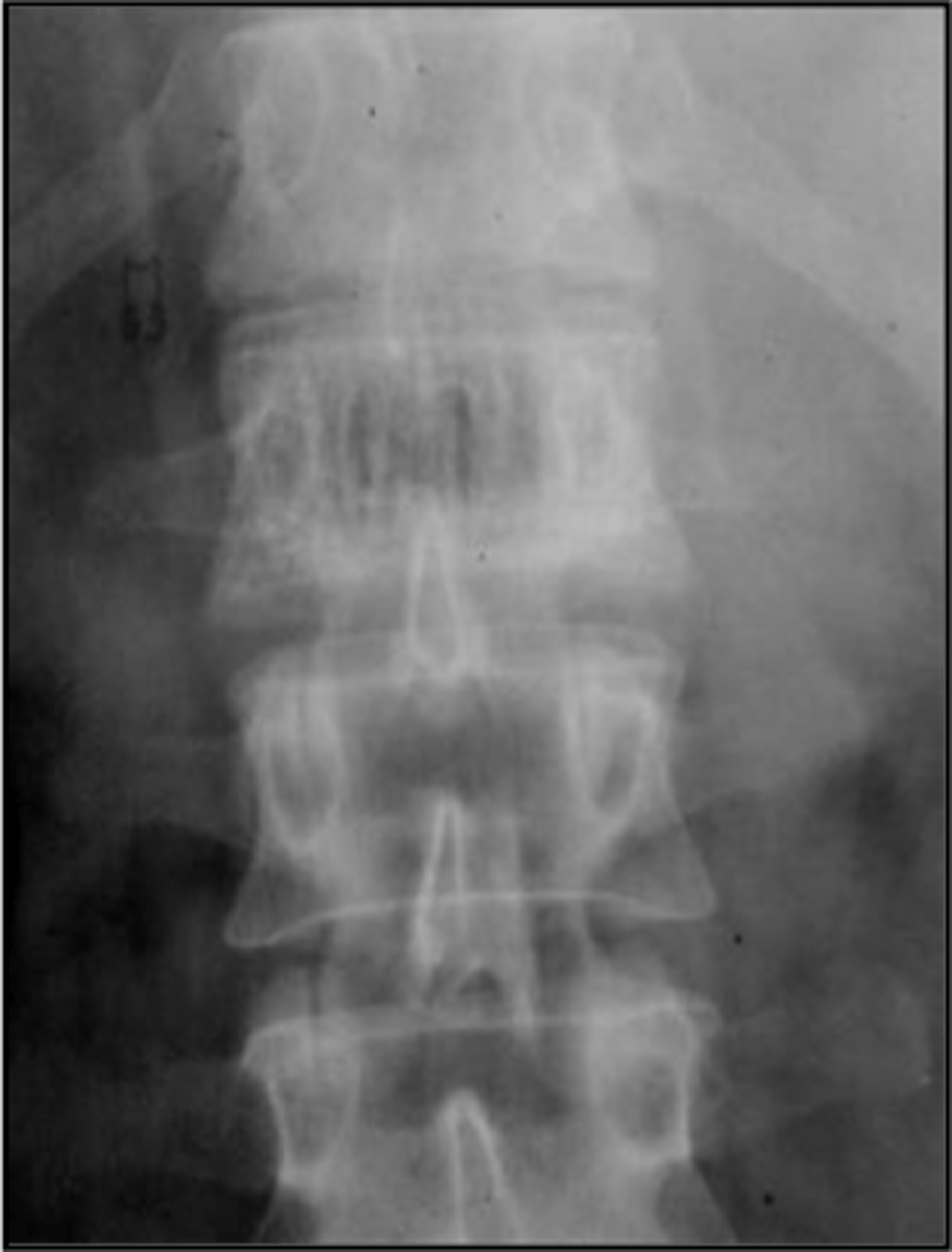 <p>State the radiographic features of vertebral hemangioma</p>