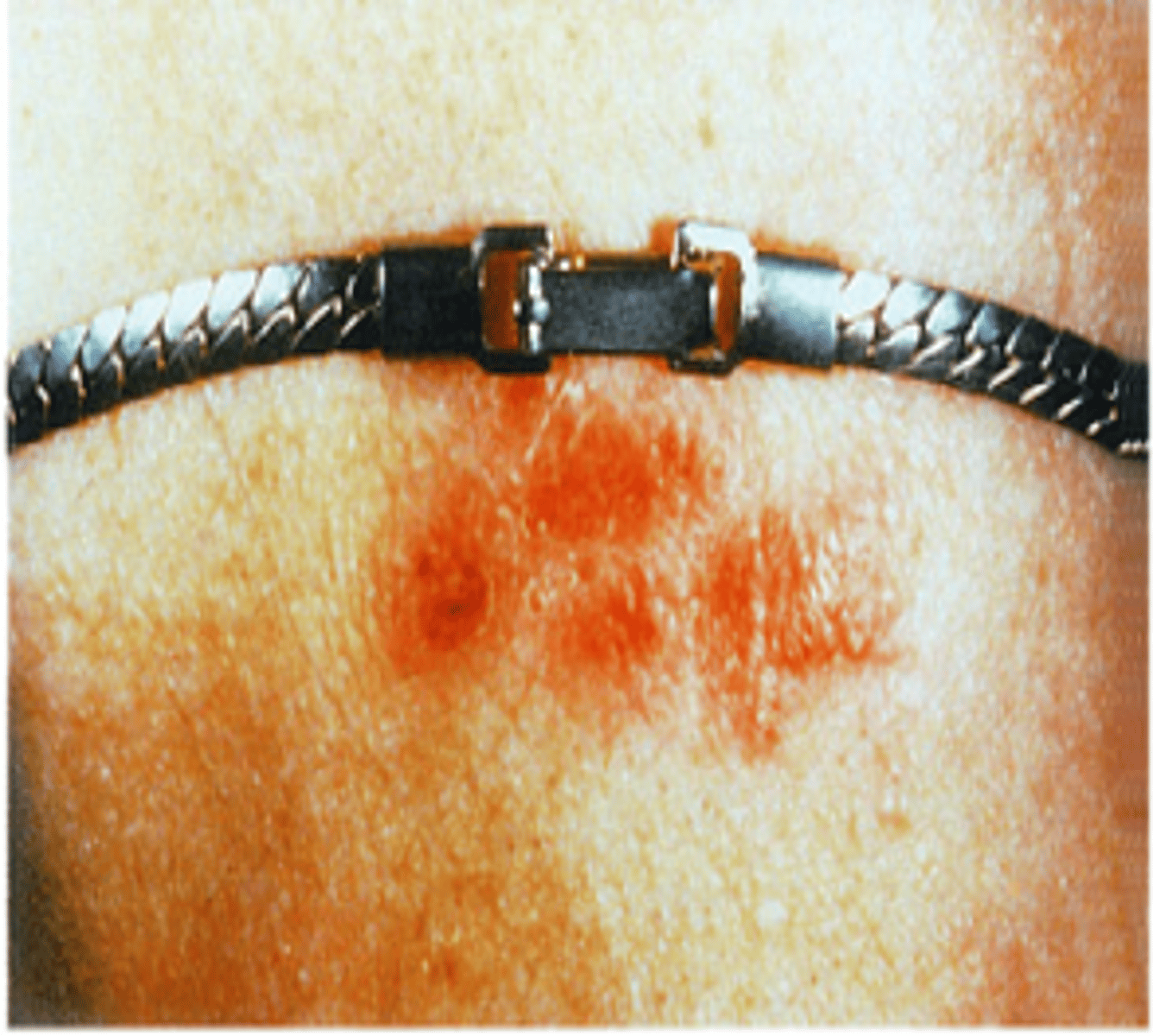 <p>Inflammatory reaction of the skin in response to irritant or allergen such as metals, plants, chemicals, and detergents</p><p>Common causes:</p><p>-Jewelry (NICKEL in metal)</p><p>-Belts</p>