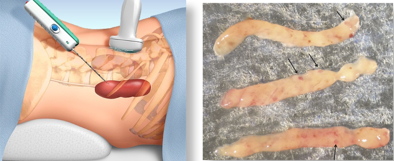 <p>Kidney biopsy</p>