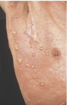 <p>CIRCUMSCRIBED, ROUND OR OVAL THIN TRANSLUCENT MASS FILLED WITH SEROUS FLUID OR BLOOD</p>