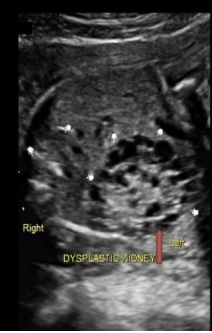 <p>which characteristics indicates multicystic kidney disease </p><p>a) multiple communicating cysts that connect to a dilated ureter</p><p>b) multiple noncommunicating cysts that do not connect to a dilated ureter</p><p>c) multiple microcysts that cause increased echogenicity of the kidney</p><p>d) multiple cysts that replace the renal sinus w/normal renal cortex</p>