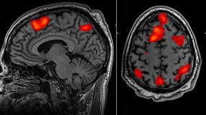 <p>fMRI (Functional Magnetic Resonance Imaging)</p>