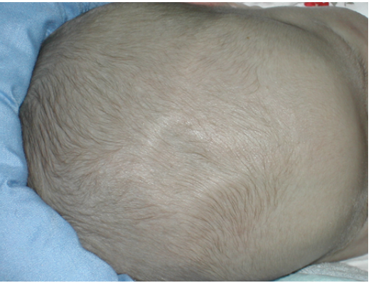 <p><span>How would you document this assessment finding located on the infant’s head?</span></p><p></p>