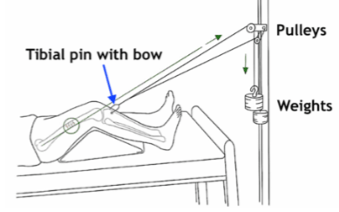 <p>- reduction - restoration of alignment</p><p>- goal is to straighten the fracture</p><p>- 2 types: external traction OR surgical reduction</p>