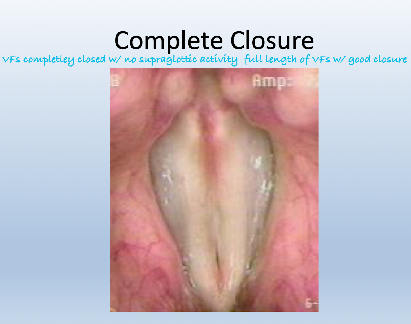 <ul><li><p>Complete closure</p></li><li><p>Spindle gap</p></li><li><p>Posterior gap</p></li><li><p>Irregular closure</p></li><li><p>Anterior gap</p></li><li><p>Hourglass</p></li><li><p>Incomplete closure</p></li><li><p>REFER TO IMAGES ON PDF!!!</p></li></ul><p></p>