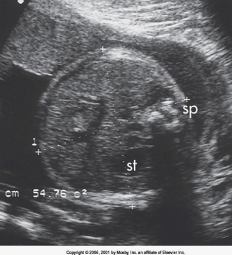 <p>measurement at level of liver, stomach, and umbilical vein intersection with PV</p><ul><li><p>at high waist (steve urkel pants) </p></li><li><p>should be mostly round</p></li></ul>