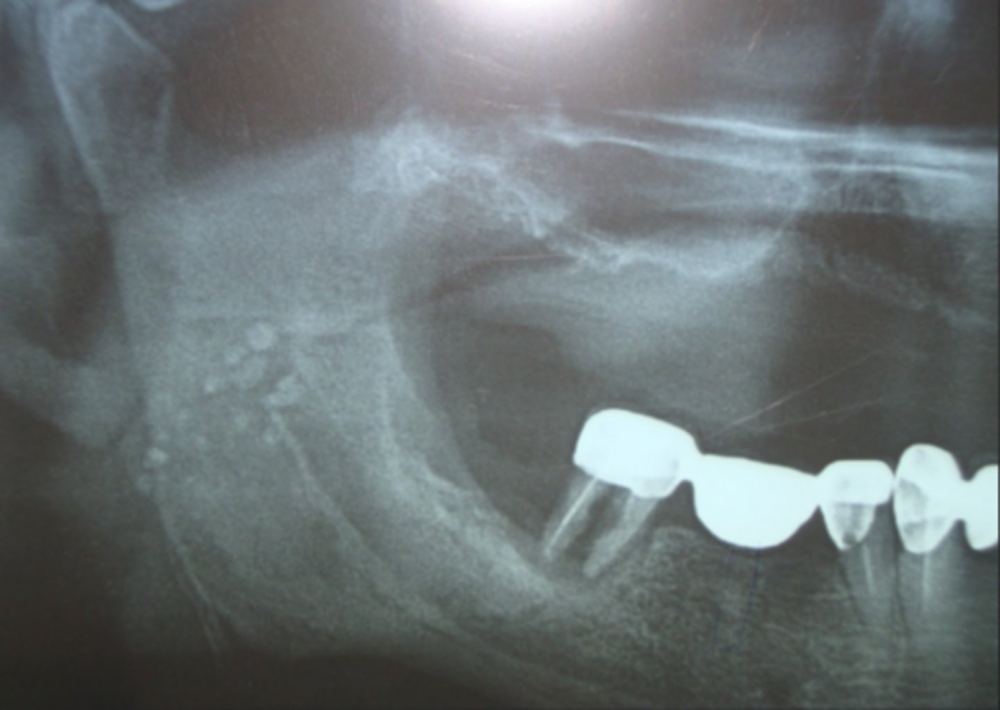 <p>Multiple small radiopacities superimposed over mandibular ramus, can be uni or bilateral</p>