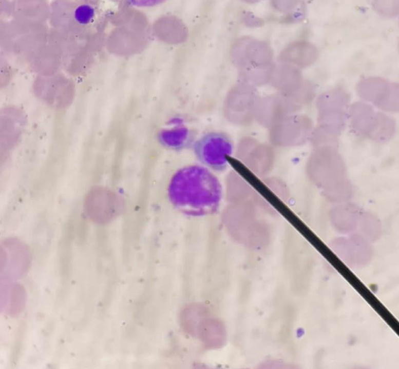 <p>A. Identify the cell (Normoblastic / Rubriblastic / Erythroblastic)</p><p>B. Striking feature</p><p>C. Describe N:C ratio</p><p>D. What is responsible for its gray cytoplasm ?</p>