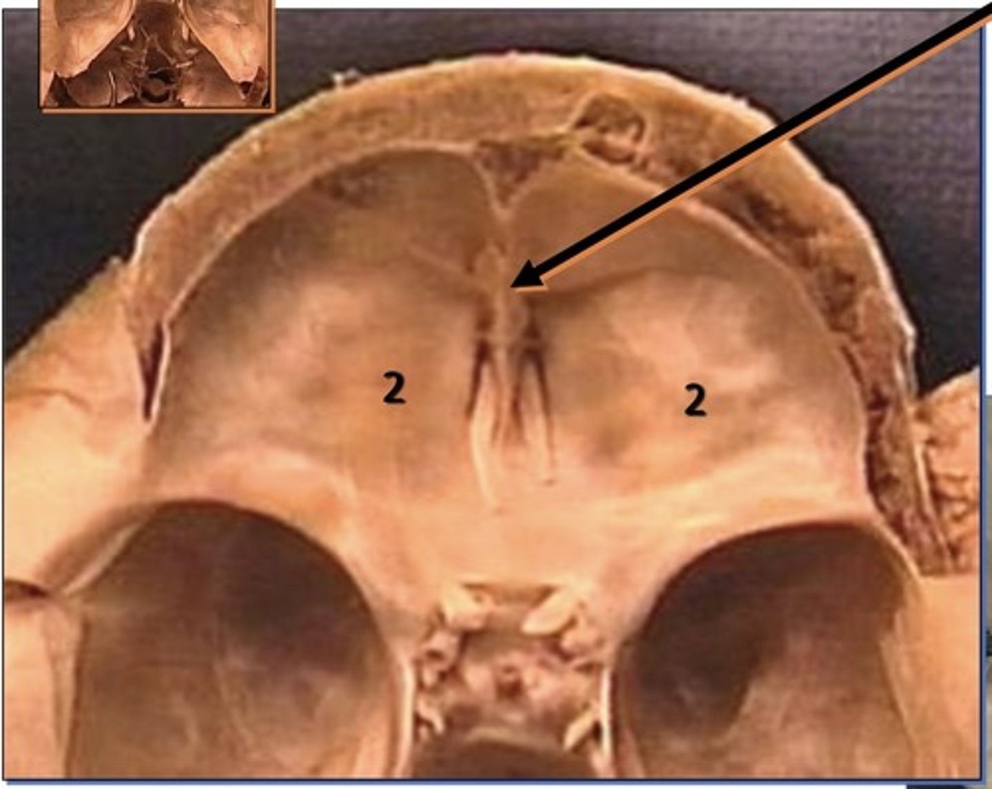<p>1. Attachment site dura</p><p>2. Sticks out like a mountain</p>