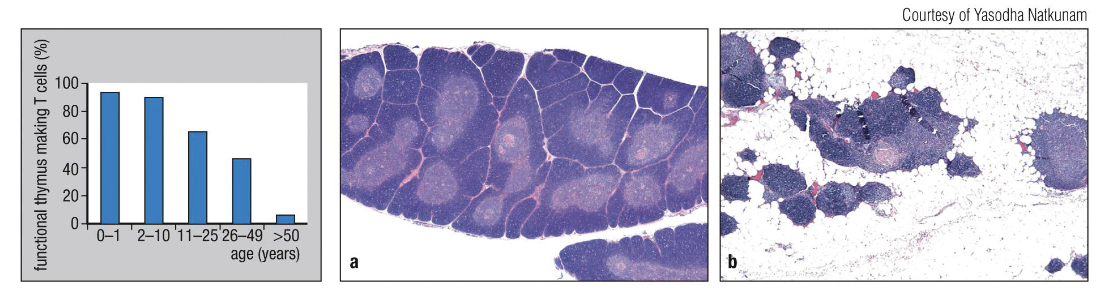 <ul><li><p>It <strong>shrinks and fills with fat </strong>(thymic involution), so <strong>fewer new T cells</strong> are made.</p></li><li><p>Removing the thymus in adults doesn’t affect existing T cells.</p></li></ul><p></p>