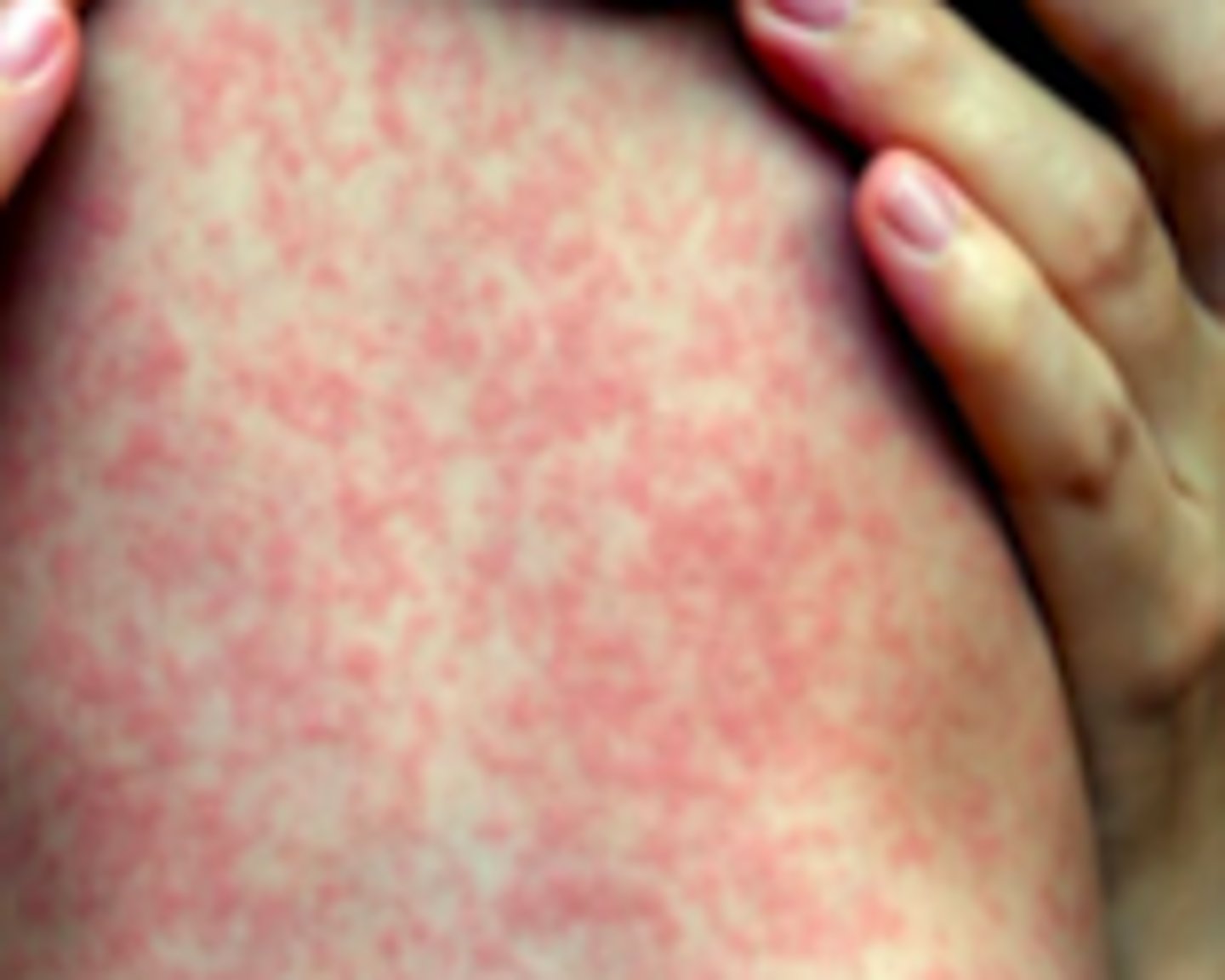 <p>Exanthems:</p><p>Subjective:</p><p>- Prodrome for 2-4 days</p><p>- Fever, malaise, anorexia, conjunctivitis, coryza, cough</p><p>- Varying severity of conjunctivitis; may also be accompanied by lacrimation or photophobia</p>