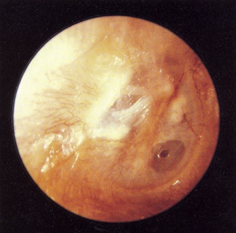 <p><u>disordered otoscopy: eardrum/TM</u></p><p>perforation</p>