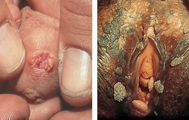 <p>cause : human papilloma-viruses ( HPV) </p><p>v-factor </p><ul><li><p>oncoproteins E6 and E7 inhibit our tumor suppressing proteins </p></li></ul><p></p>