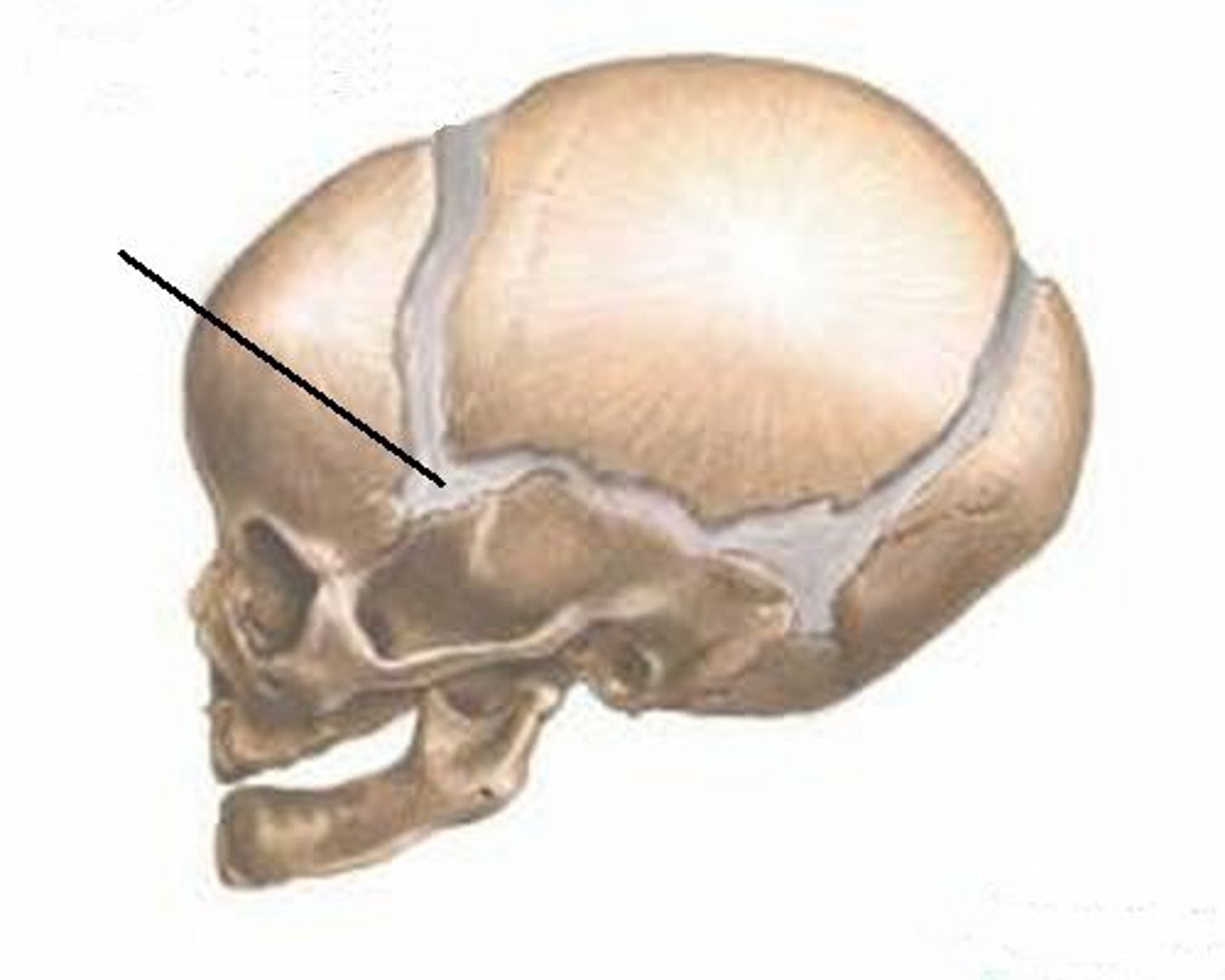 <p>at the junction between the squamous sutures and the coronal suture</p>