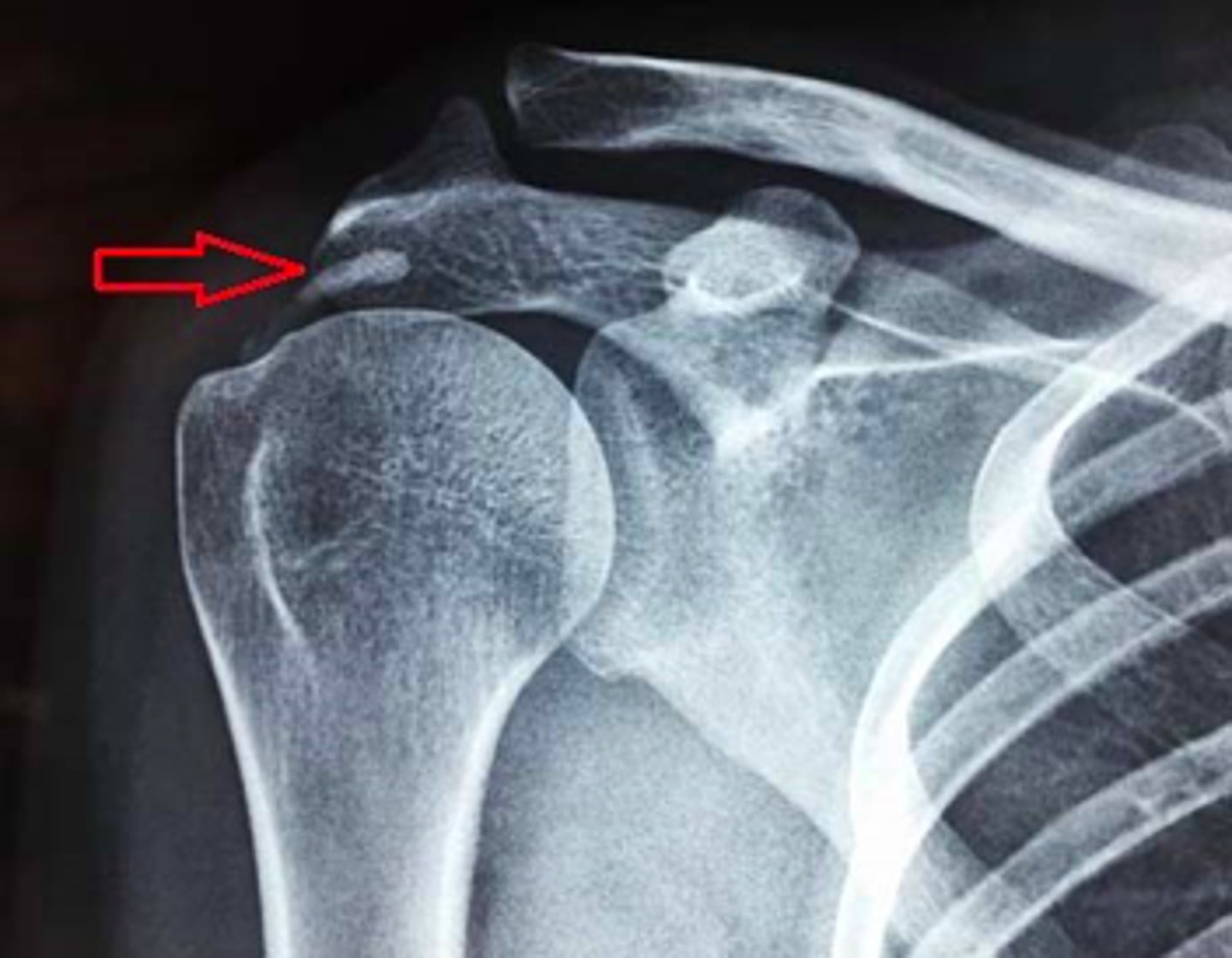 <p>XR: AP and lateral (Y-view)</p><p>- +/- Proximal migration of the humerus</p><p>- Traction osteophytes</p><p>- Calcification of the coracoacromial ligament</p><p>- Cystic changes within the greater tuberosity</p>