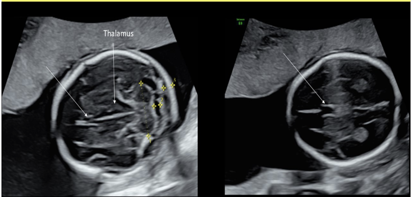 <p>c) cavum septum pellucidum</p>