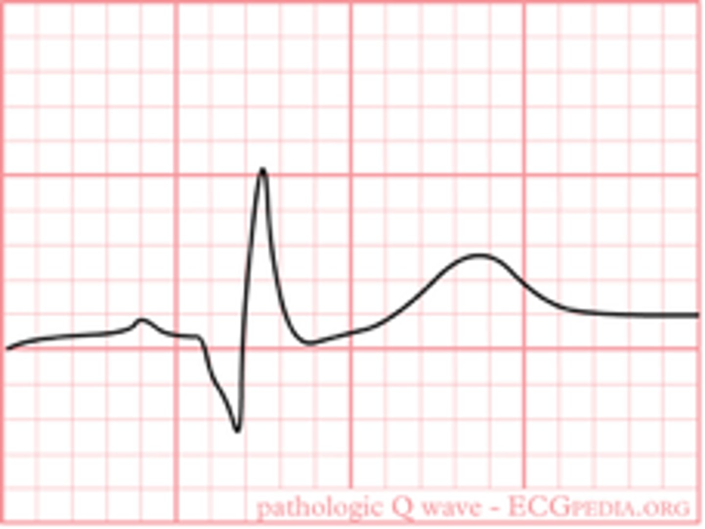 <p>Significant Q wave (1 small box wide or 1/3 QRS amplitude)</p>