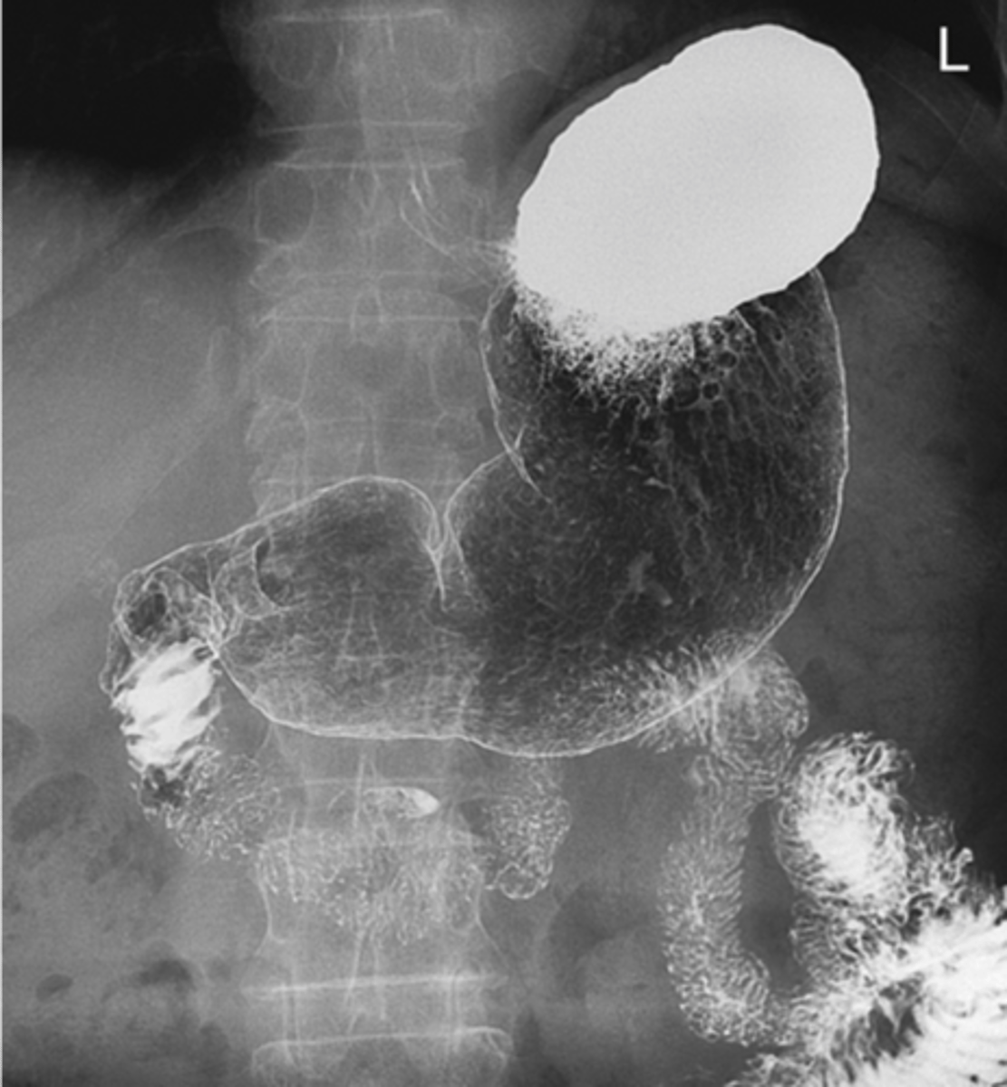 <p>What is gastritis ?</p>