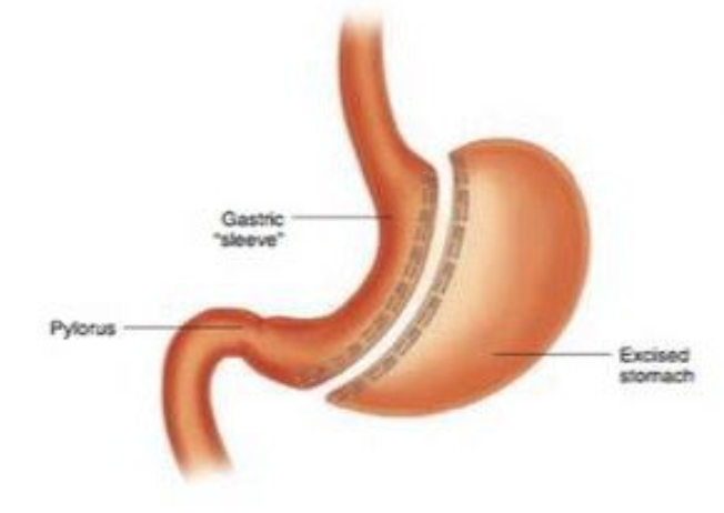 <p>Vertical sleeve gastrectomy</p>