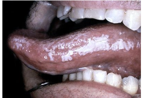 <p><strong><em>___________ </em></strong>is an irregular and corrugated white lesion most commonly occurring on the lateral border of the tongue. Occurs most often by EBV or in patients with HIV.</p>