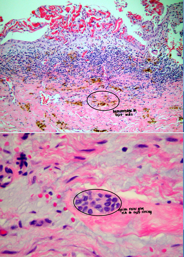<p>epithelial rests</p>