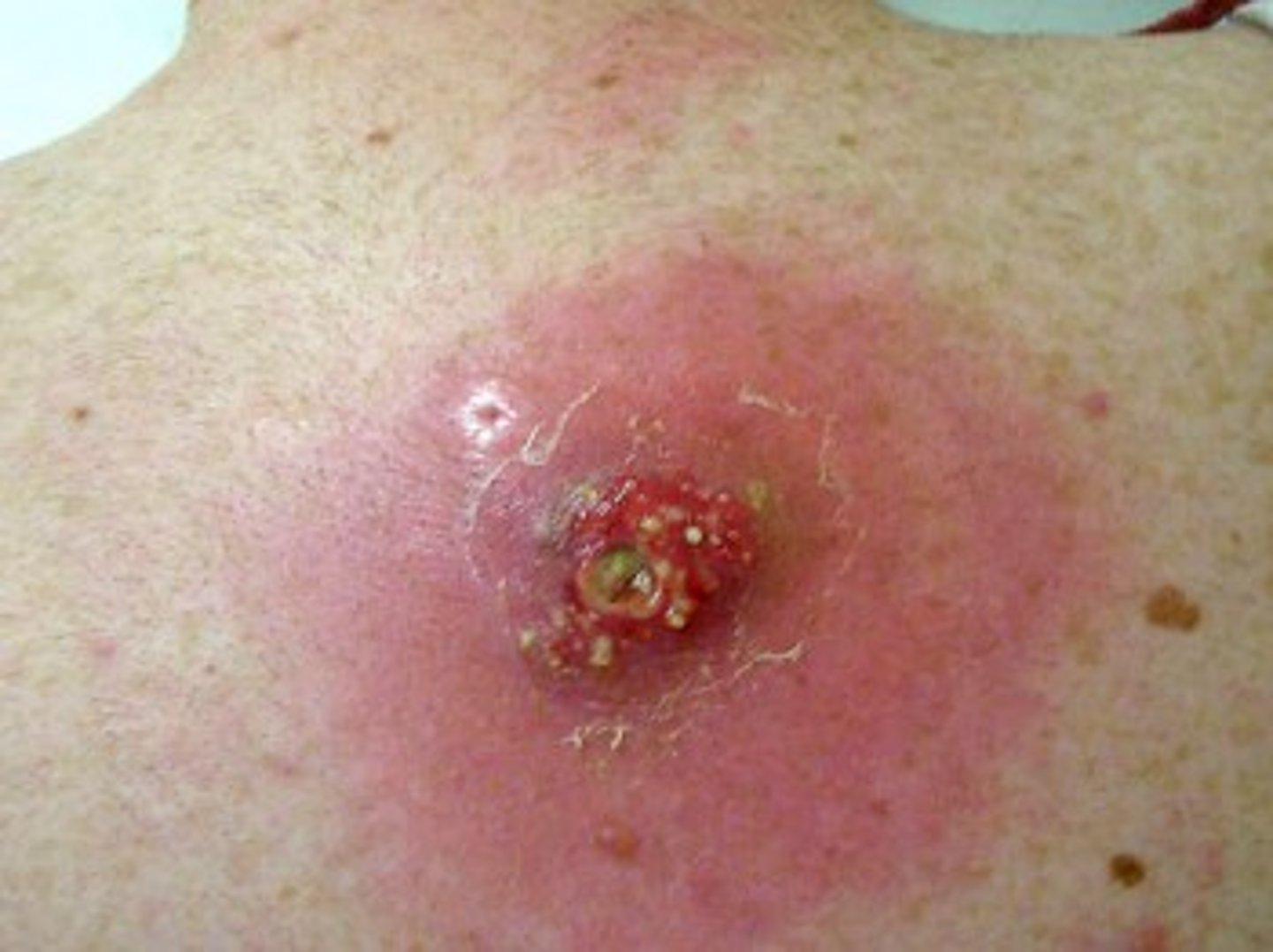 <p>Methicillin-resistant Staphylococcus aureus.</p>