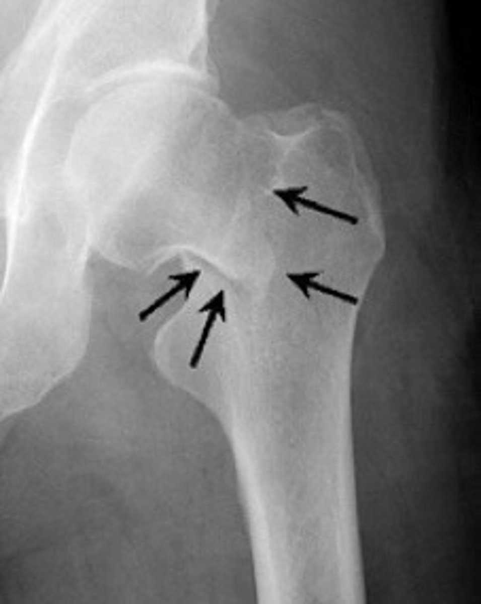<p>What type of fracture is shown?</p>