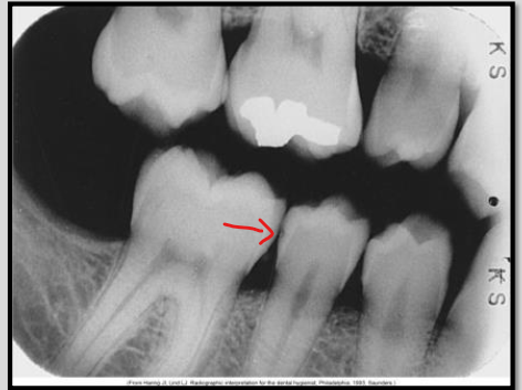 <p>What class of interproximal caries is this?</p>
