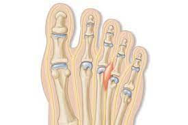 Pinching of interdigital nerve (3rd + 4th metatarsal)