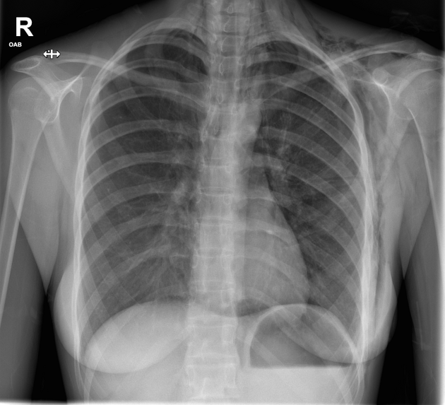 <p>Describe the abnormality demonstrated. </p>