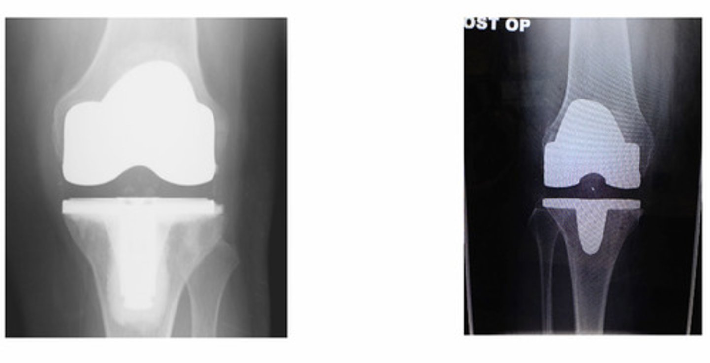 <p>What procedure was done to this pt?</p>