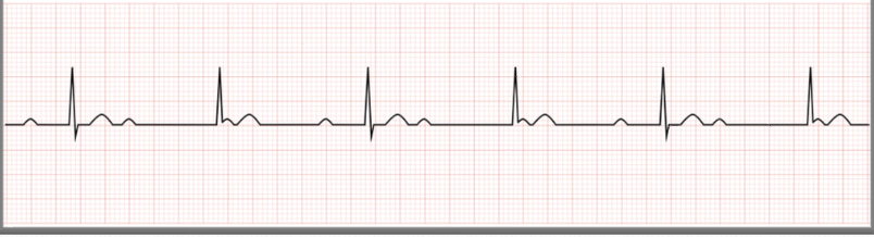 <ul><li><p class=""><strong>Atria and ventricles</strong> beat independently of each other.</p></li><li><p class=""><strong>P waves</strong> are not associated with QRS complexes.</p></li></ul><p class=""><strong>Treatment</strong>:</p><ul><li><p class="">Atropine can be given but is usually ineffective.</p></li><li><p class="">Transcutaneous, transvenous, or implanted <strong>permanent pacemaker.</strong></p></li></ul><p></p>