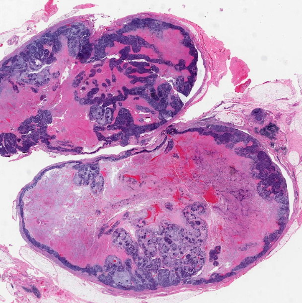 <p>Patient de 50 ans avec tumeur de la parotide </p><p>1) Diagnostic</p><p>2) Localisation </p><p>3) Histo</p><p>4) IHC</p><p>5) Moléculaire</p>