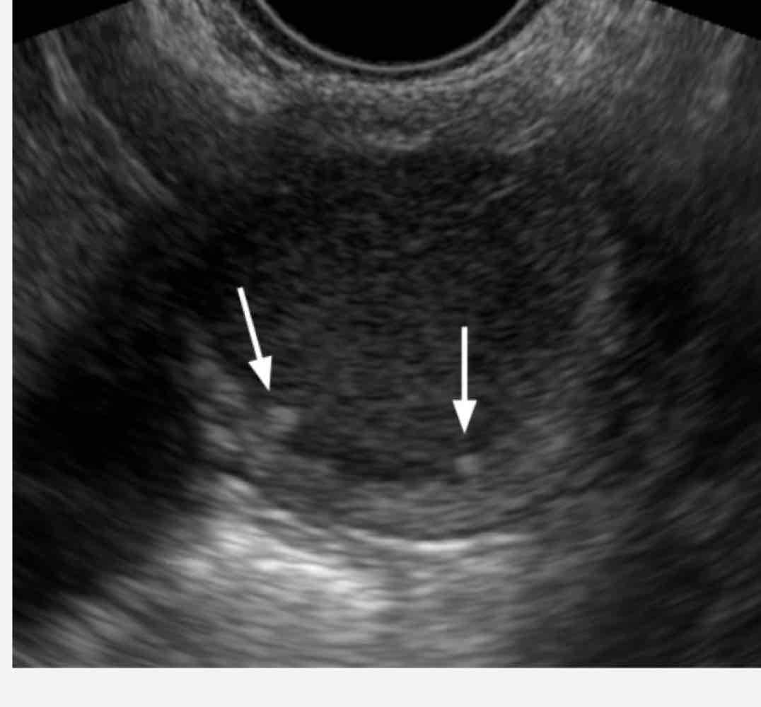 <p>cystic mass with papillary projections arising from the endometriosis</p><p>Age: 50-60 yo</p>