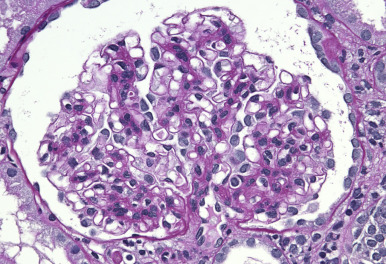 <p>TYPE 3 HYPERSENSITIVITY</p><p>Targets many organs via nucleic proteins with antinuclear antibodies. Picture is nephritis caused by this</p>