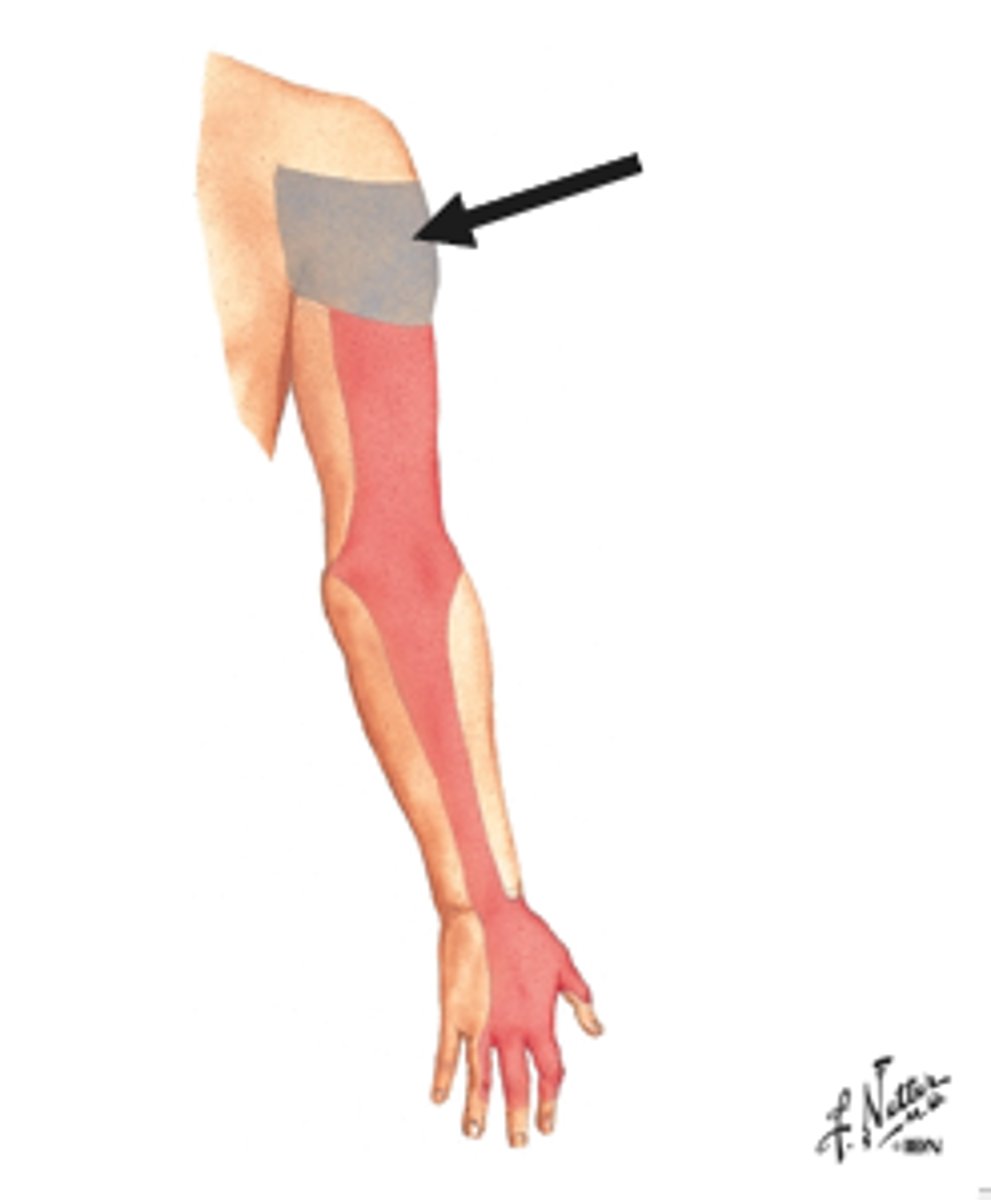 <p>the axillary nerve becomes the upper lateral cutaneous nerve of the arm and supplies the skin covering the lower 1/2 of the deltoid and upper part of the triceps long head</p>
