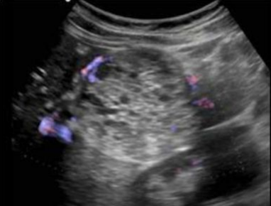<p><span style="color: yellow;">< 2cm</span></p><p>Cystic/septated on US</p><p><span style="color: yellow;">Head of pancreas</span></p><p>thin, well-defined capsule with septations/fluid-filled cysts</p><p><span style="color: yellow;">“Central star”</span> appearance</p>