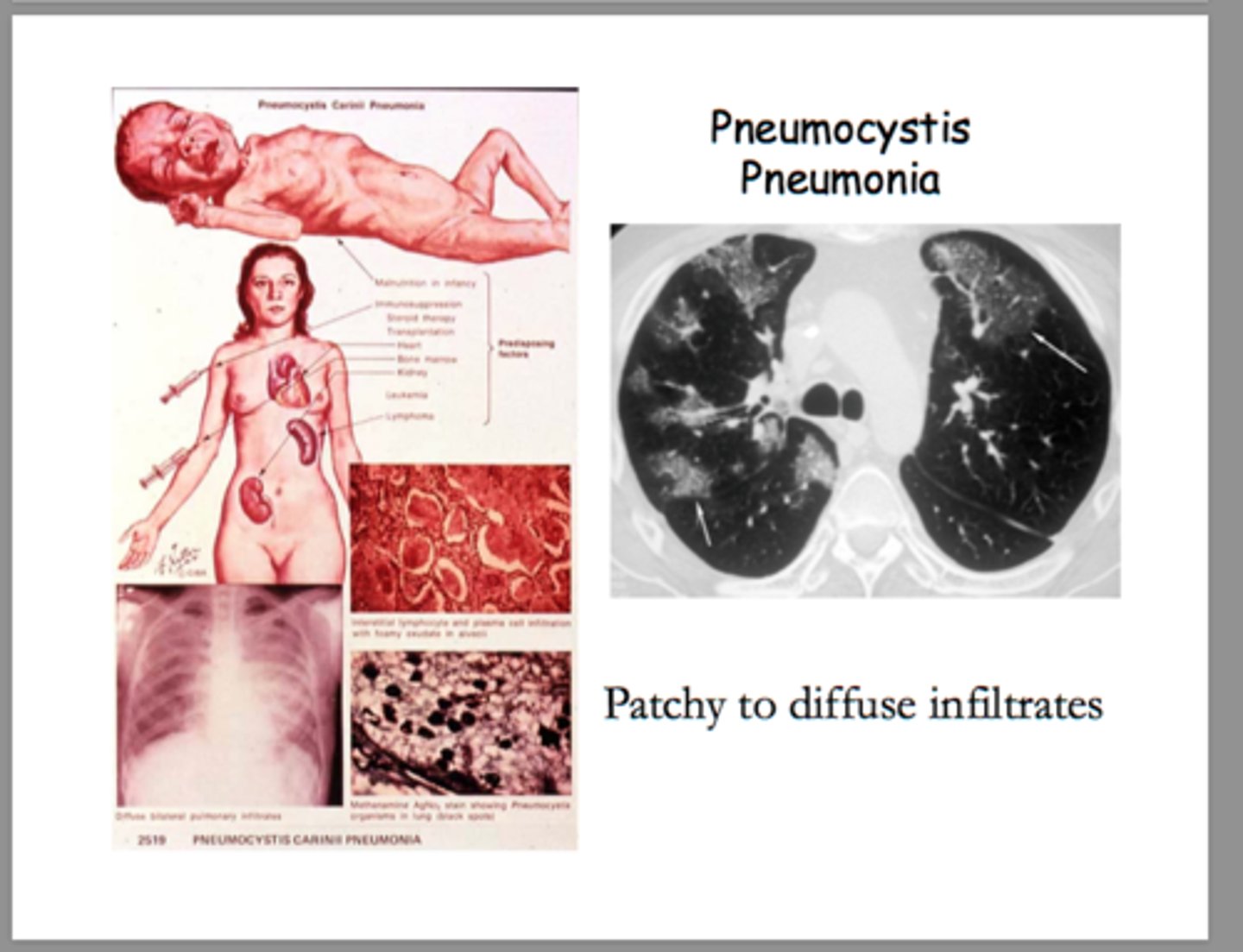 <p>Prevents Pneumocystis Pneumonia (PCP) during pregnancy</p>