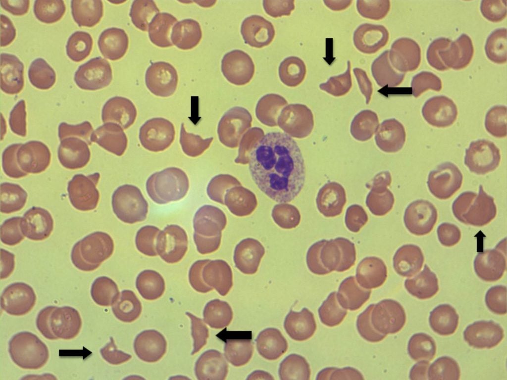 <p>Cause: premature destruction of RBCs</p><p>-increase in reticulocytes</p><p>-inherited defects of membrane (SPEROCYTOSIS)</p><p>-inherited defects of hemoglobin (SICKLE CELL)</p><p>-antibody mediated destruction (HEMOLYTIC NEWBORN DISEASE &amp; SLE)</p><p>-mechanical trauma (Defective valves, marathon)</p><p>-infections of RBCs (MALARIA)</p>