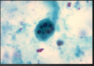 <p>Is an intestinal and tissue amoeba and is the only known pathogenic intestinal amoeba</p><ul><li><p>Consists of two stages: the non-motile cyst (infective stage) and the motile trophozoite (pathogenic stage).</p></li><li><p>the <strong>trophozoite</strong> is found within the intestinal and extraintestinal lesions and in diarrheal stools:</p></li><li><p><strong>cysts </strong>are found in non-diarrheal formed stools</p></li></ul><p></p>