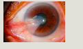 <p>pterygium</p>