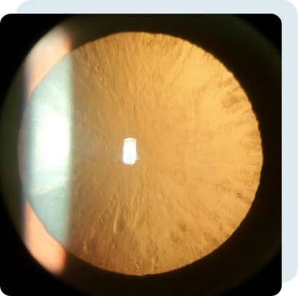 <p>1. RE changes</p><p>2. cortical vacuoles (imaged) - develop into opacities</p><p>3. cataracts (age-related, snowflake)</p>