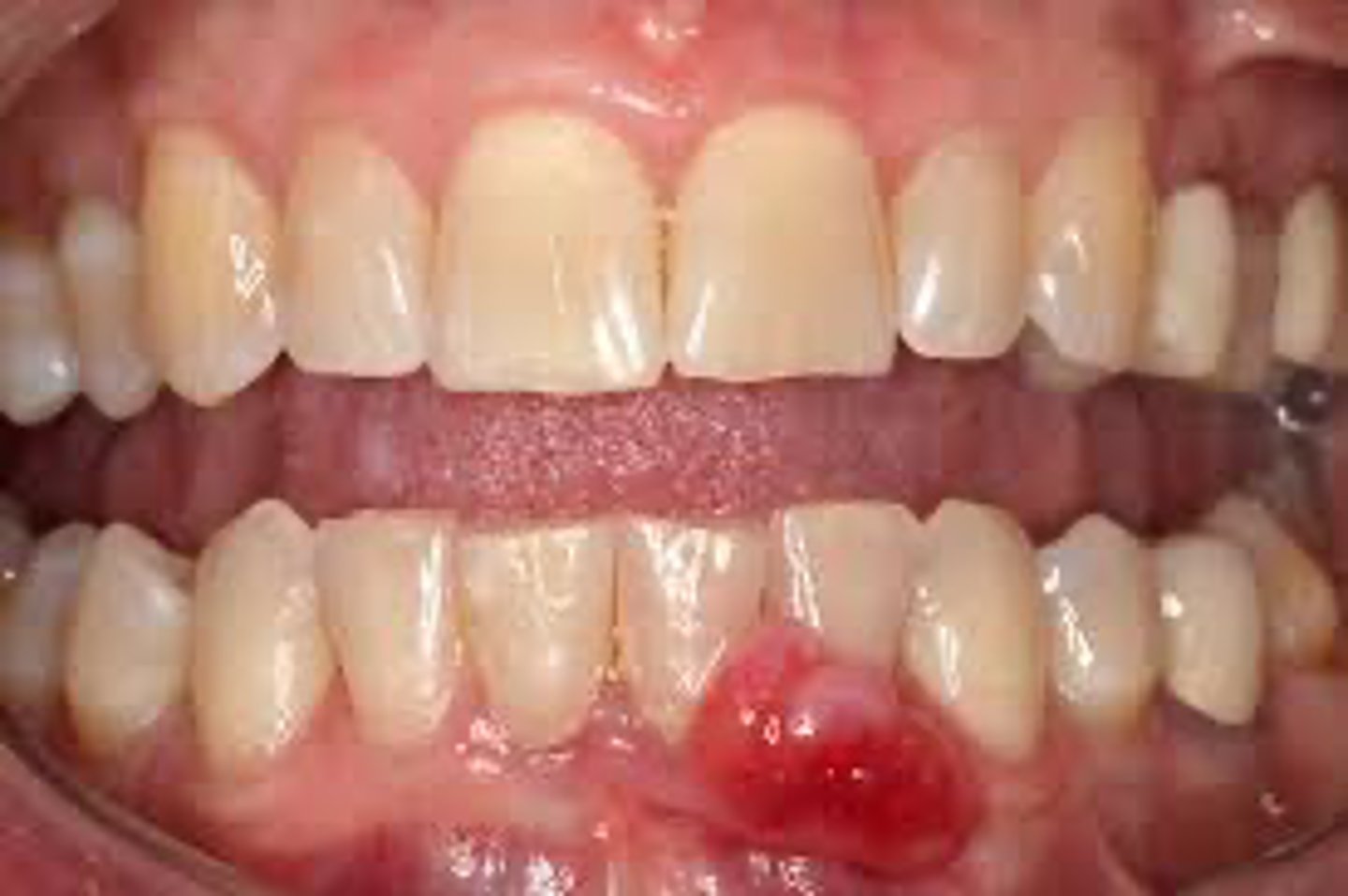 <p>A patient presents with a well-defined, exophytic gingival mass that is pedunculate. The lesion is located on the attached gingiva and appears pink and firm.</p><p>What is the most likely diagnosis?</p>