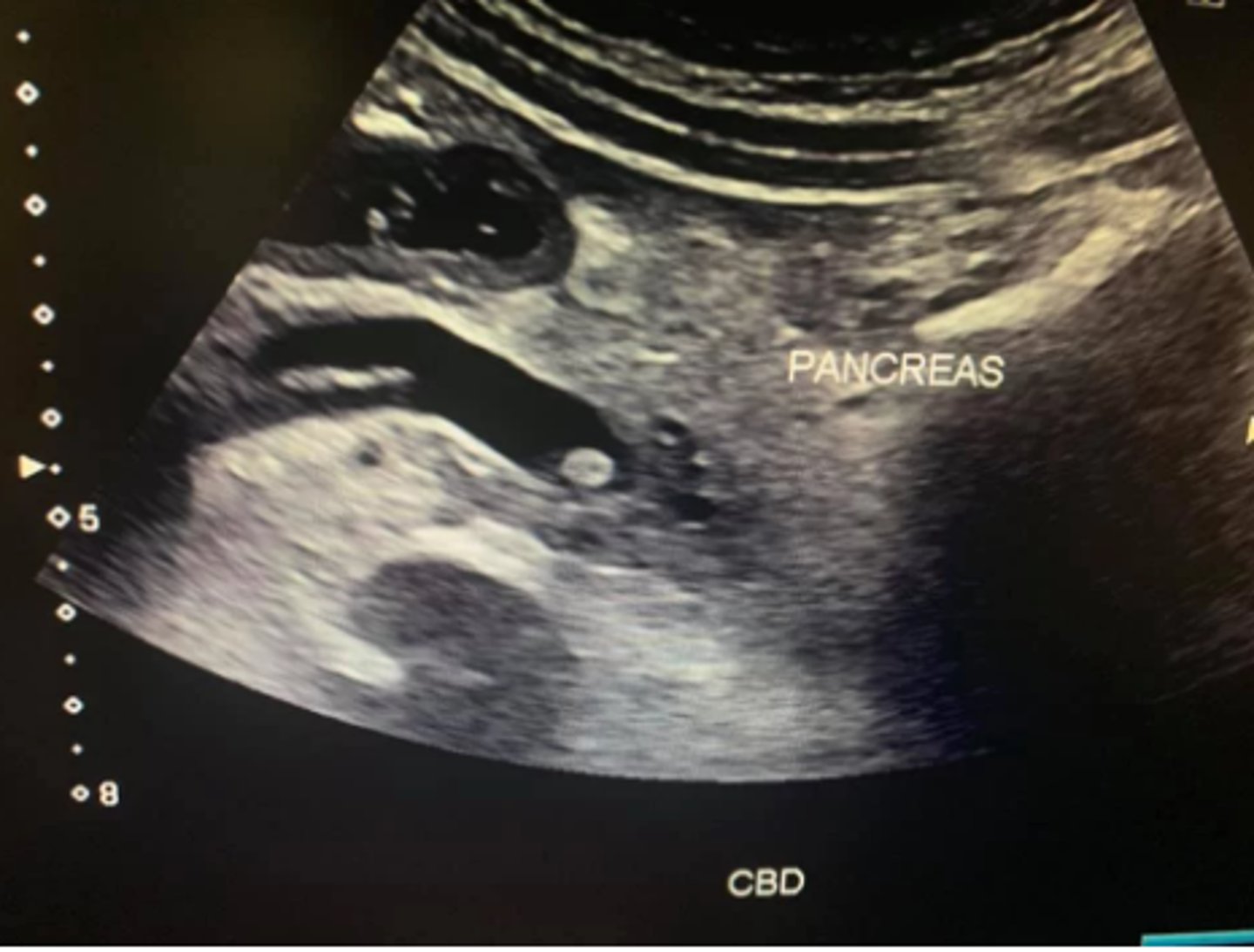 <p>a. Choledocholithiasis</p>