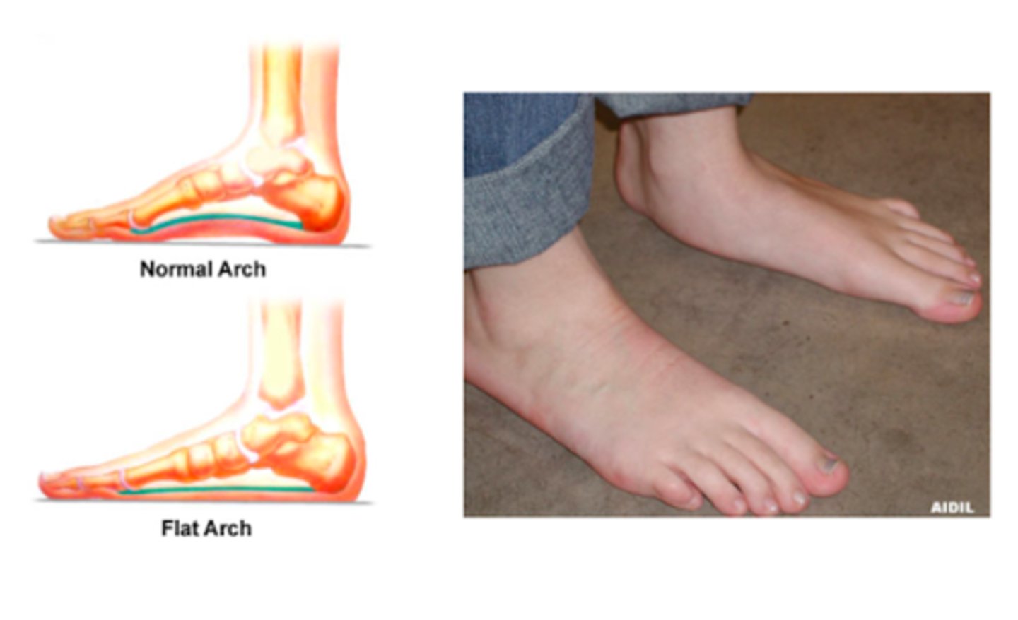 <p>PT</p><p>Arch support</p><p>NSAIDs</p><p>If ADLs affected → ortho referral</p>