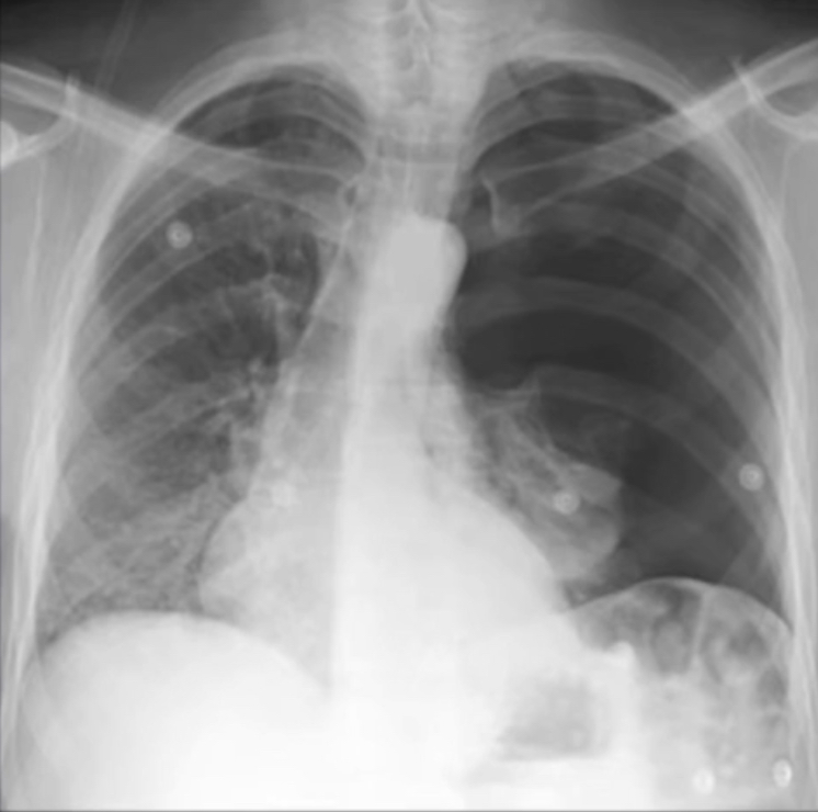 <p>42 year old comes in with acute SOB. What is the diagnosis based off of this chest x-ray?</p>
